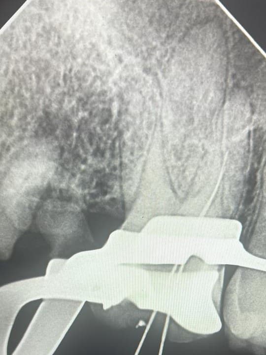 Radiografia periapical utilizada na investigação da origem da dor