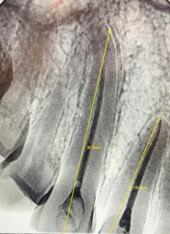 Radiografia periapical com aferição de comprimento durante avaliação endodôntica