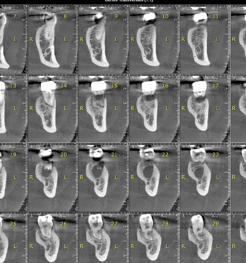 Tomografia computadorizada de feixe cônico — cortes transversais